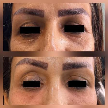 F-EYE CONTOR درمان تیرگی و چروک دور چشم