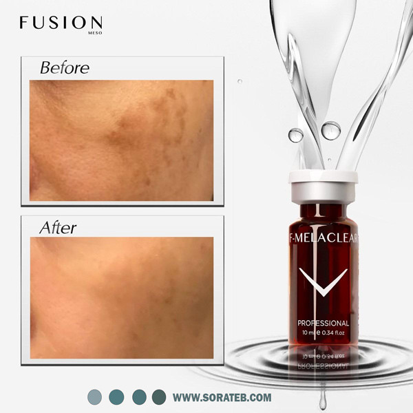 F-MELACLEAR 10ml درمان ملاسما و ناهمواری رنگ پوست و درمان لک های ب شدت تیره و قهوه ای